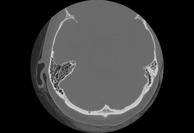File:Bilateral otospongiosis (Radiopaedia 35447-36940 B 49).jpg