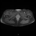 Bilateral ovarian fibroma (Radiopaedia 44568-48293 Axial T1 C+ fat sat 30).jpg