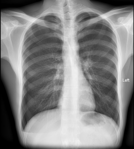File:Bilateral spontaneous pneumothorax (Radiopaedia 61525).PNG