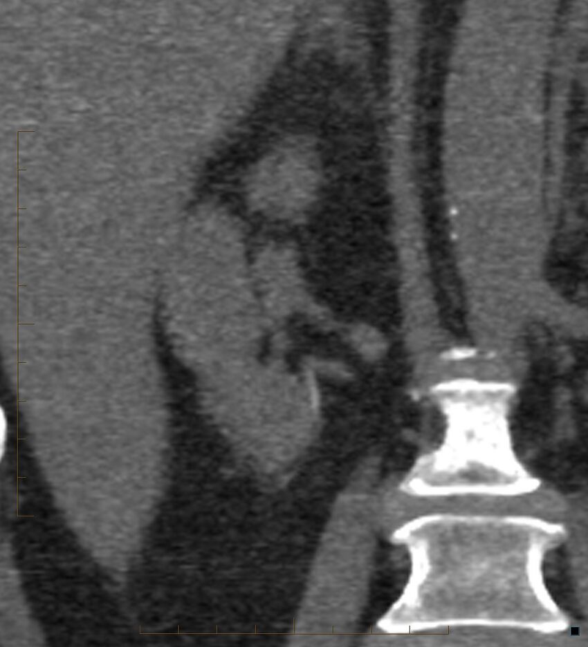 Bile leak from accessory duct(s) of Luschka post cholecystectomy (Radiopaedia 40736-43389 B 49).jpg