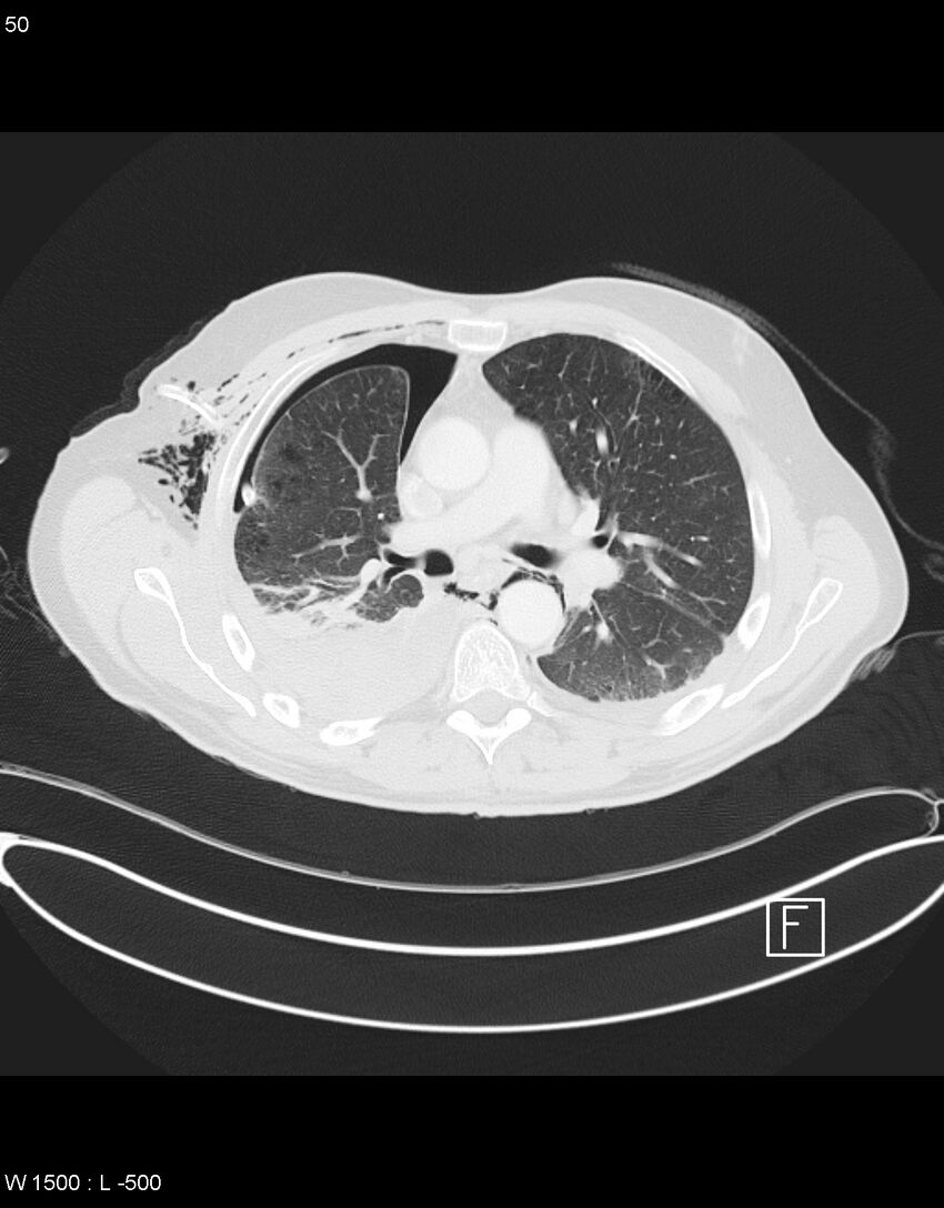 Boerhaave syndrome with tension pneumothorax (Radiopaedia 56794-63605 Axial lung window 24).jpg