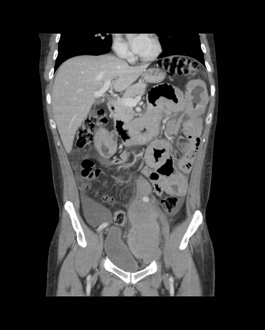 Bowel lymphoma complicated by bleeding after therapy (Radiopaedia 55601-62107 B 30).jpg
