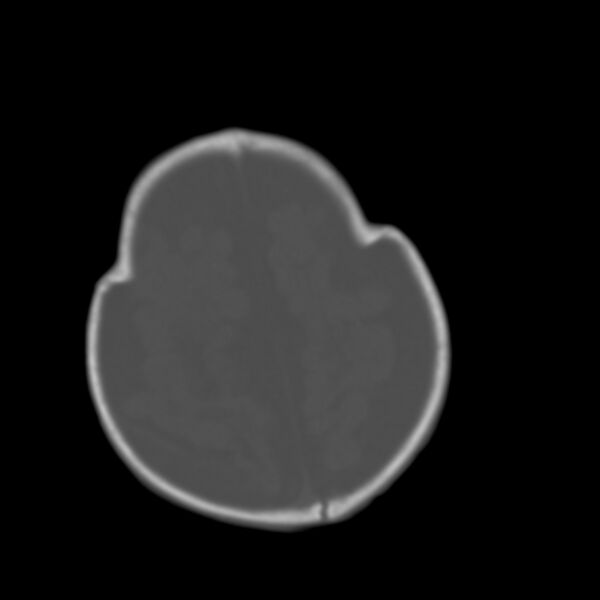 File:Brachycephaly (bi-coronal and bi-lambdoid synostosis) (Radiopaedia 55048-61413 Axial bone window 20).jpg