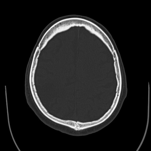 File:Brain Pantopaque remnants (Radiopaedia 78403-91048 Axial bone window 50).jpg