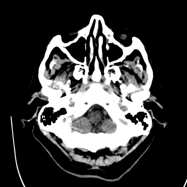 File:Brain Pantopaque remnants (Radiopaedia 78403-91048 Axial non-contrast 21).jpg
