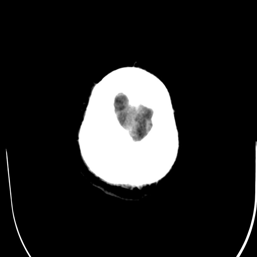 Brain Pantopaque remnants (Radiopaedia 78403-91048 Axial non-contrast 87).jpg