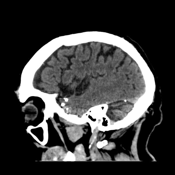 File:Brain Pantopaque remnants (Radiopaedia 78403-91048 C 43).jpg
