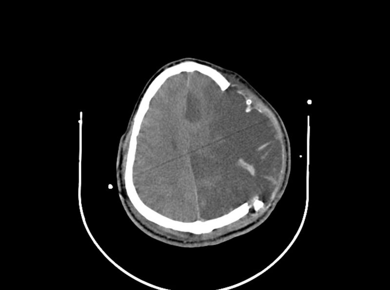 File:Brain injury by firearm projectile (Radiopaedia 82068-96087 B 134).jpg