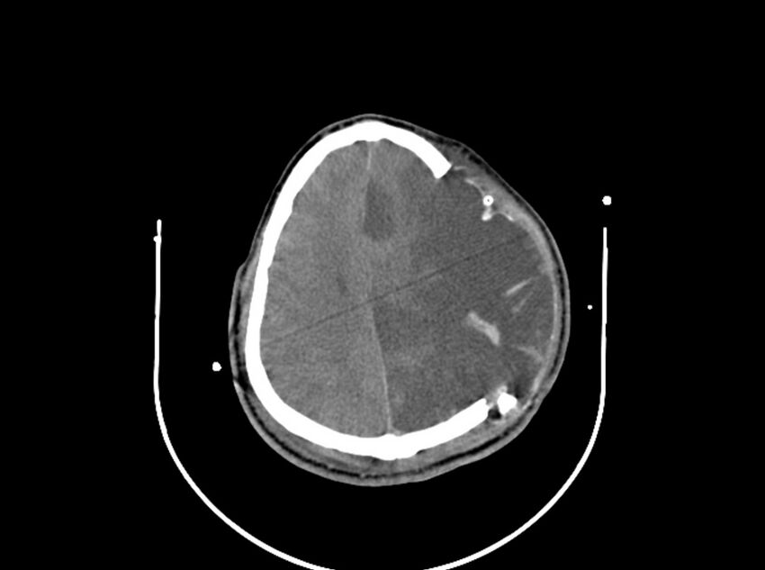 Brain injury by firearm projectile (Radiopaedia 82068-96087 B 134).jpg