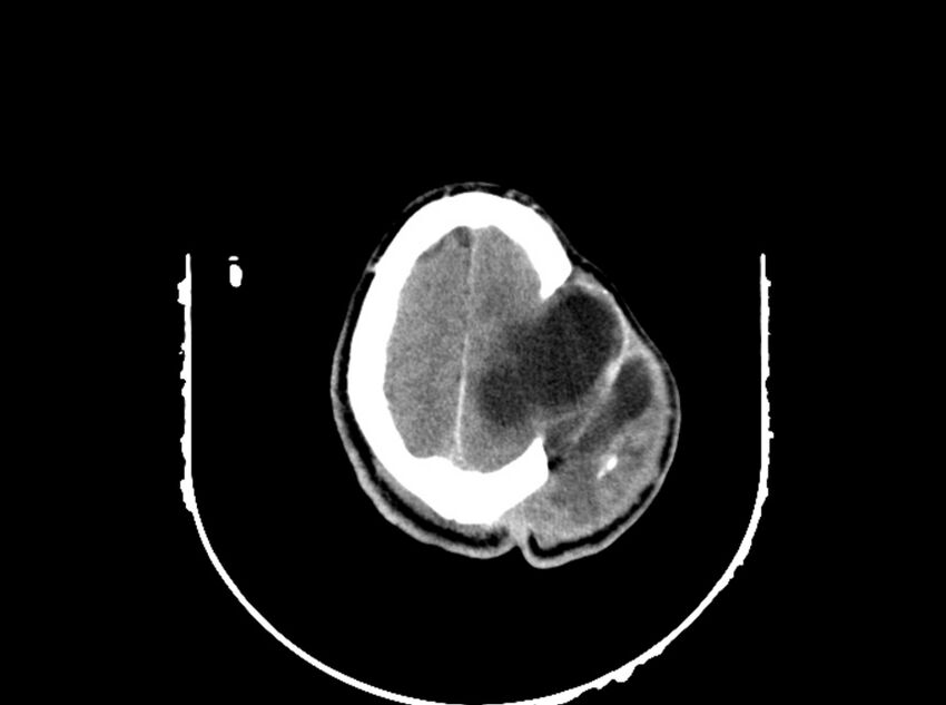 Brain injury by firearm projectile (Radiopaedia 82068-96088 A 179).jpg