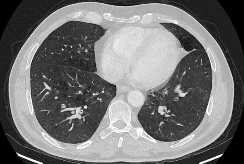 File:Brain metastases - lung cancer primary (Radiopaedia 75060-86116 Axial lung window 42).jpg