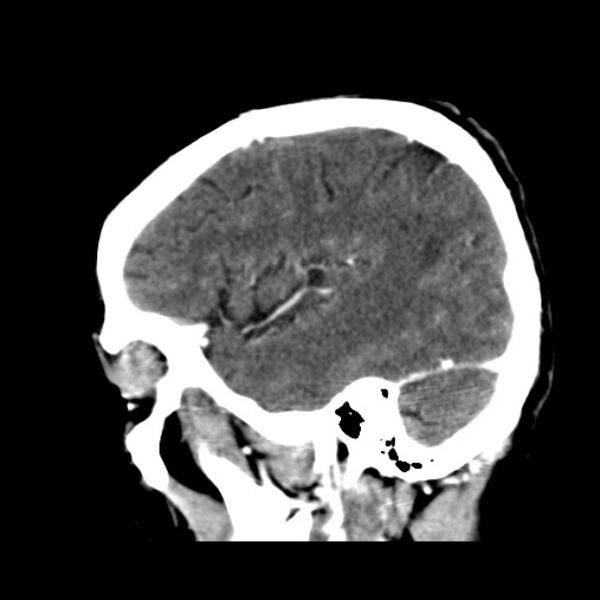 File:Brain metastases from lung cancer (Radiopaedia 24480-24781 C+ delayed 14).jpg