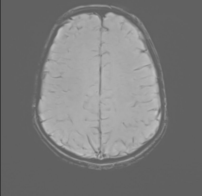 Brainstem glioma (Radiopaedia 70548-80674 Axial SWI 46).jpg