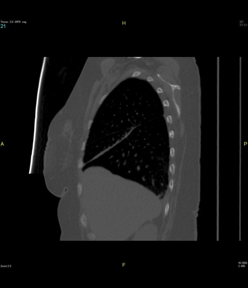 Breast primary with lung and bone metastases (Radiopaedia 40620-43228 Sagittal bone window 21).jpg
