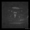 Broad ligament fibroid (Radiopaedia 49135-54241 Axial DWI 25).jpg