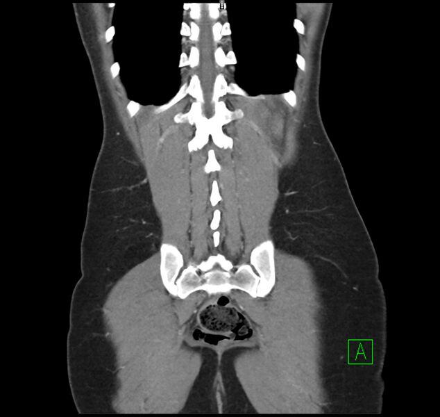 File:Broad ligament hernia (Radiopaedia 63260-71832 B 32).jpg