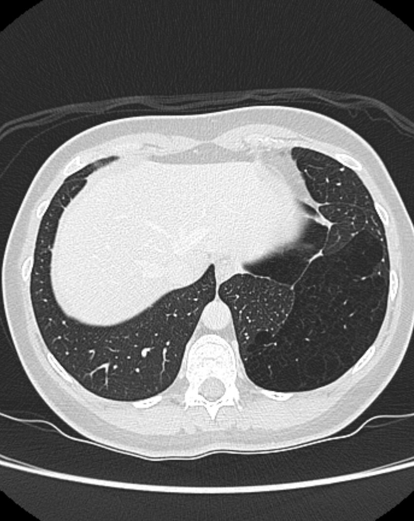 Bronchial atresia (Radiopaedia 50007-55297 Axial lung window 93).jpg