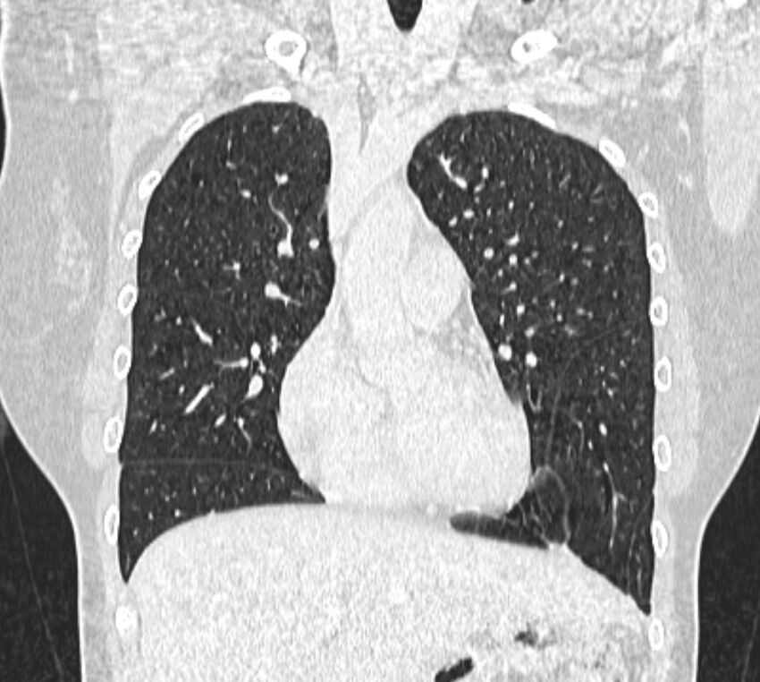 Bronchial atresia (Radiopaedia 50007-55297 Coronal lung window 34).jpg