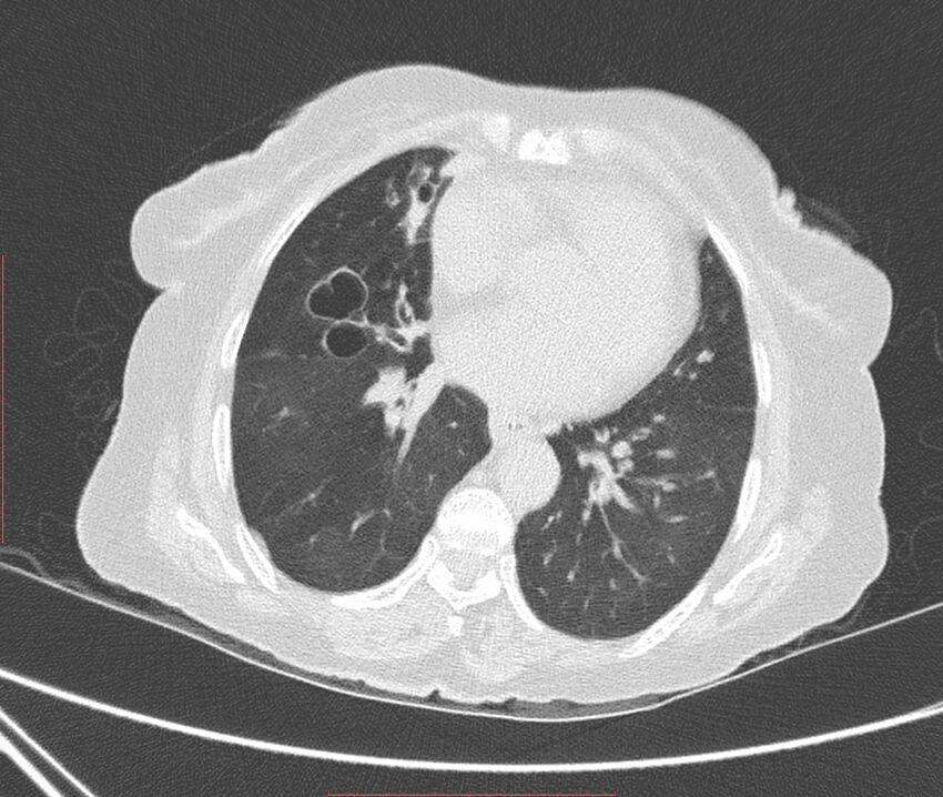 Bronchiectasis (Radiopaedia 72693-83293 Axial lung window 81).jpg
