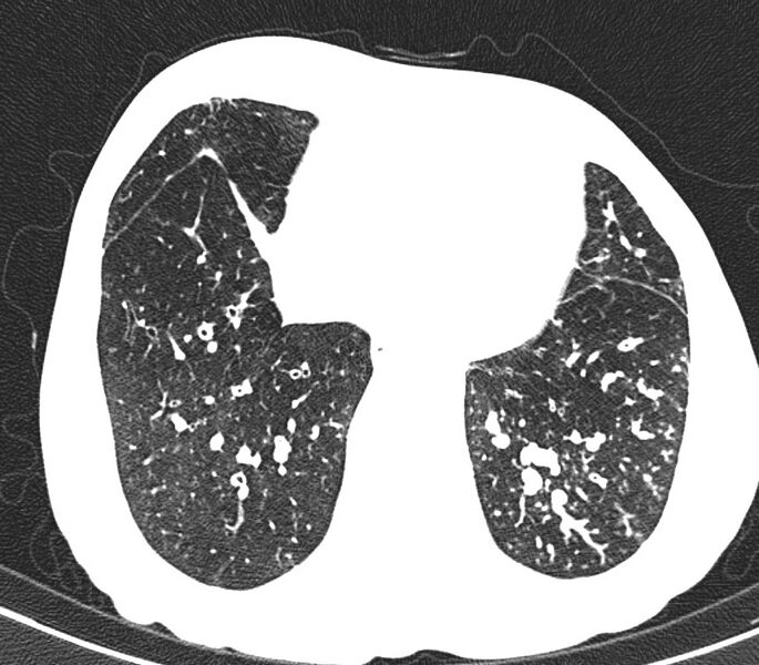 File:Bronchiolitis (Radiopaedia 24616-24887 Axial lung window 46).jpg