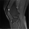 Bucket handle tear - lateral meniscus (Radiopaedia 7246-8187 Sagittal T2 fat sat 7).jpg