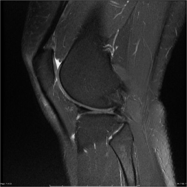 File:Bucket handle tear - lateral meniscus (Radiopaedia 7246-8187 Sagittal T2 fat sat 7).jpg