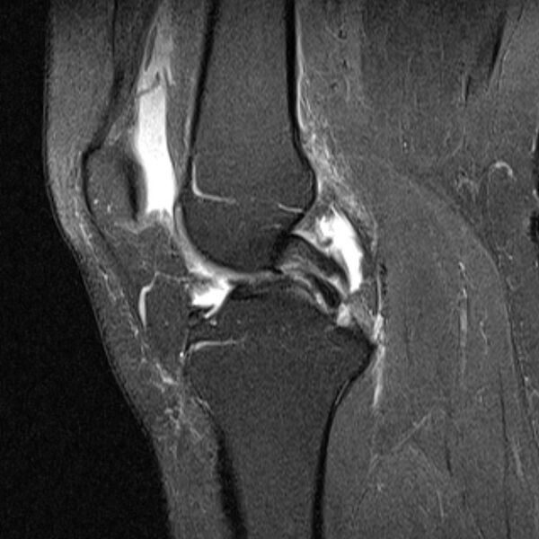 File:Bucket handle tear - medial meniscus (Radiopaedia 79028-91942 Sagittal PD fat sat 14).jpg