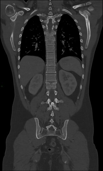 File:Burst fracture (Radiopaedia 83168-97542 Coronal bone window 52).jpg