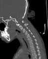 Butterfly vertebra (Radiopaedia 77903-90209 Sagittal bone window 63).jpg