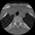 C5 facet fracture (Radiopaedia 58374-65499 Axial bone window 95).jpg