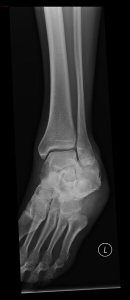 File:Calcaneal fracture and associated spinal injury (Radiopaedia 17896-17655 D 1).jpg