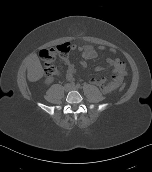 File:Calcified hepatic hydatid cyst (Radiopaedia 81127-94738 Axial non-contrast 64).jpg