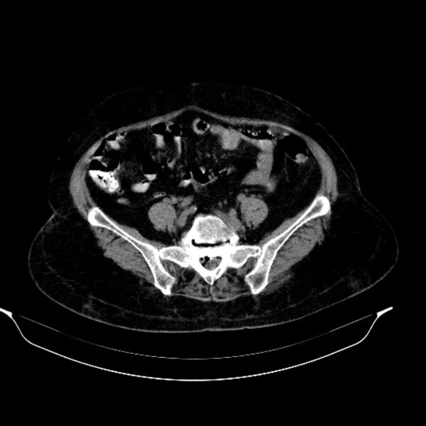 File:Calcified hydatid cyst (Radiopaedia 62000-70085 Axial non-contrast 78).jpg