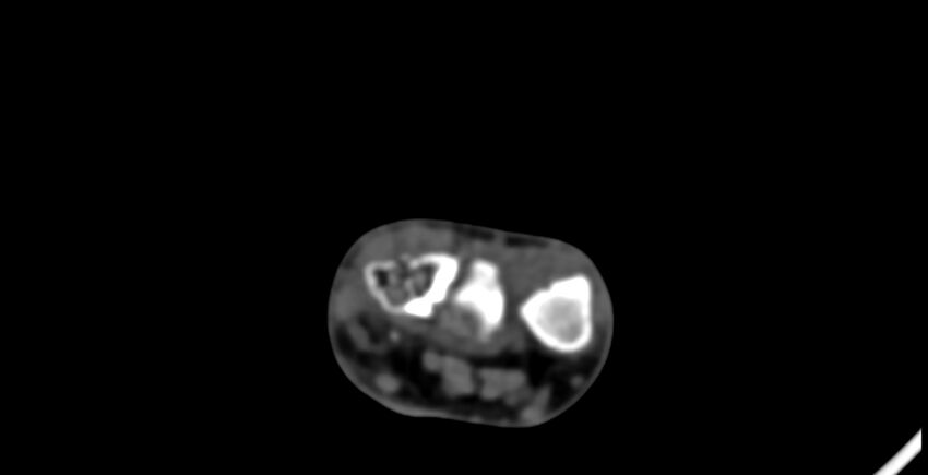 Calcifying aponeurotic fibroma (Radiopaedia 88423-105064 B 27).jpg