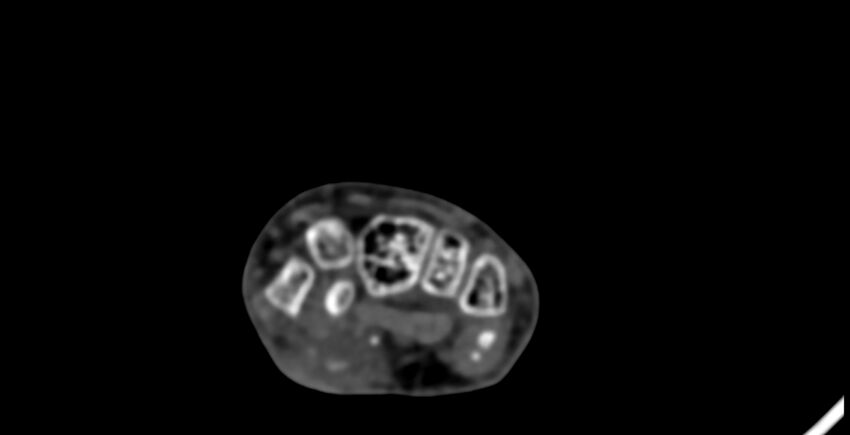 Calcifying aponeurotic fibroma (Radiopaedia 88423-105064 B 81).jpg
