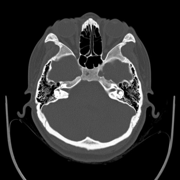 File:Calvarial osteoma (Radiopaedia 36520-38079 Axial bone window 28).jpg