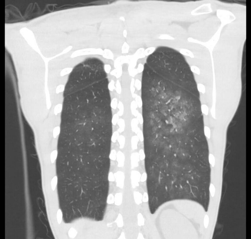 Cannabis-induced diffuse alveolar hemorrhage (Radiopaedia 89834-106946 Coronal lung window 16).jpg