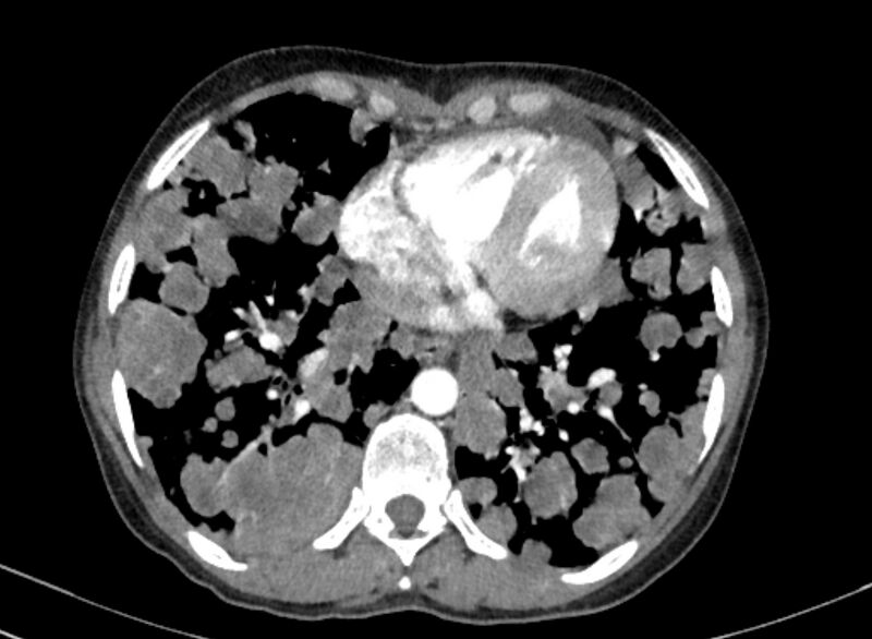 File:Cannonball metastases from breast cancer (Radiopaedia 91024-108569 A 86).jpg