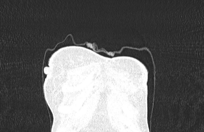 File:Cannonball metastases from breast cancer (Radiopaedia 91024-108569 Coronal lung window 6).jpg