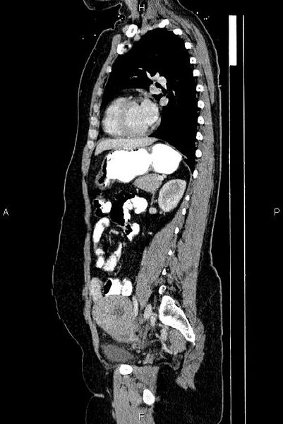 File:Carcinoma of uterine cervix (Radiopaedia 85861-101700 D 54).jpg