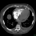 Cardiac tamponade (Radiopaedia 20909-20841 D 1).jpg