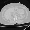 Cardiogenic pulmonary edema (Radiopaedia 29213-29609 Axial lung window 124).jpg
