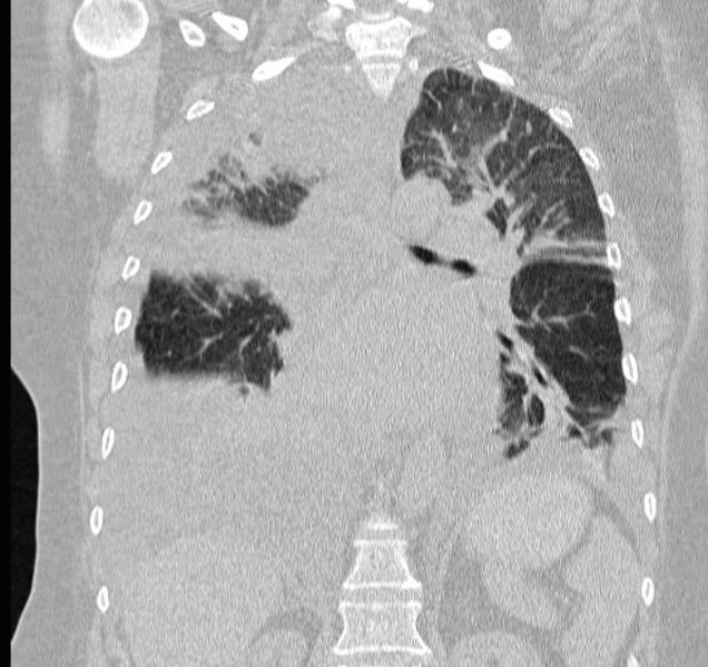 File:Cardiogenic pulmonary edema (Radiopaedia 29213-29609 Coronal lung window 42).jpg
