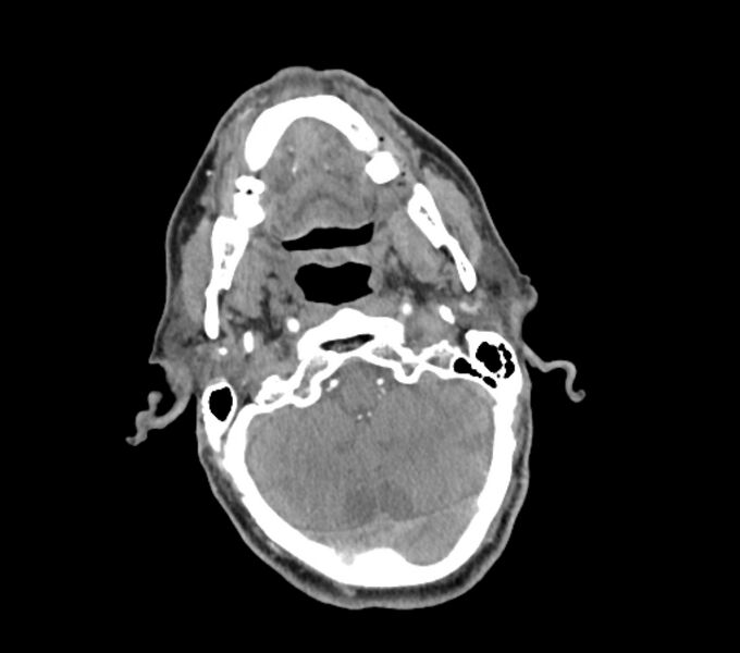 File:Carotid artery pseudoaneurysm (Radiopaedia 84030-99259 C 18).jpg