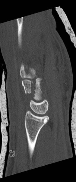 File:Carpal fractures (smart watch impaction) (Radiopaedia 55844-62430 Sagittal bone window 19).jpg