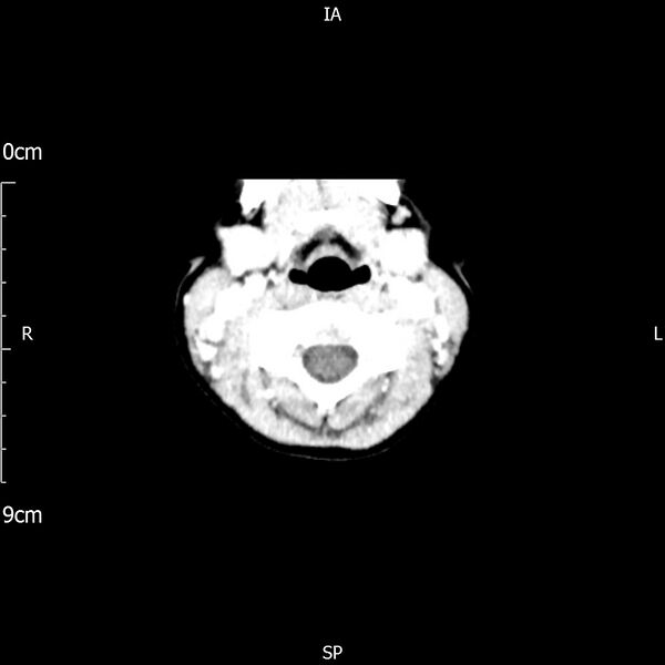 File:Cavernous sinus thrombosis (Radiopaedia 79414-92510 Axial Brain 9).jpg
