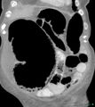 Cecal distension and secondary ischemia (Radiopaedia 19824-19874 D 1).jpg