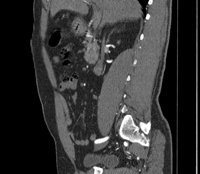 File:Celiac artery dissection (Radiopaedia 52194-58080 B 5).jpg