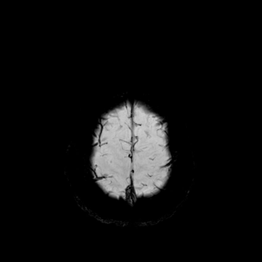 Central neurocytoma (Radiopaedia 79320-92380 Axial SWI 127).jpg