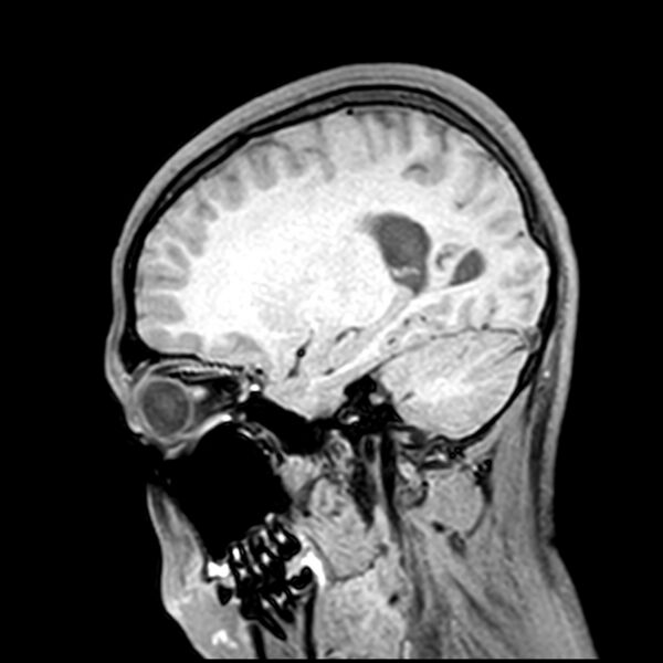 File:Central neurocytoma (Radiopaedia 79320-92380 Sagittal T1 88).jpg
